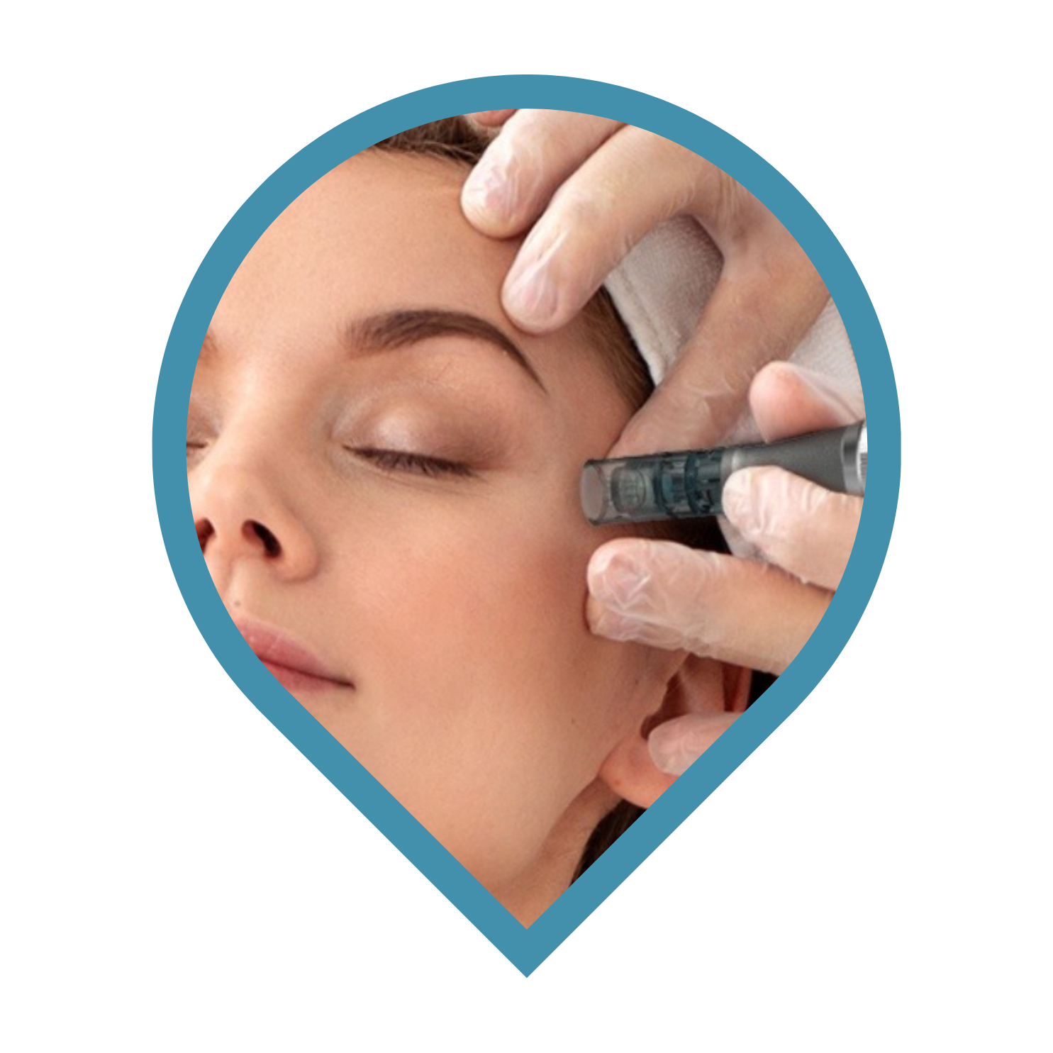 Microneedling